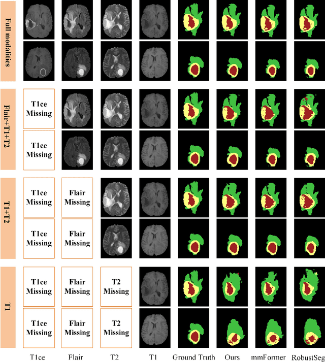 Figure 3 for A Multimodal Feature Distillation with CNN-Transformer Network for Brain Tumor Segmentation with Incomplete Modalities