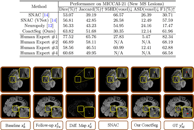 Figure 4 for CoactSeg: Learning from Heterogeneous Data for New Multiple Sclerosis Lesion Segmentation