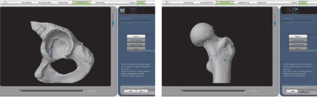 Figure 1 for Partial-to-Full Registration based on Gradient-SDF for Computer-Assisted Orthopedic Surgery