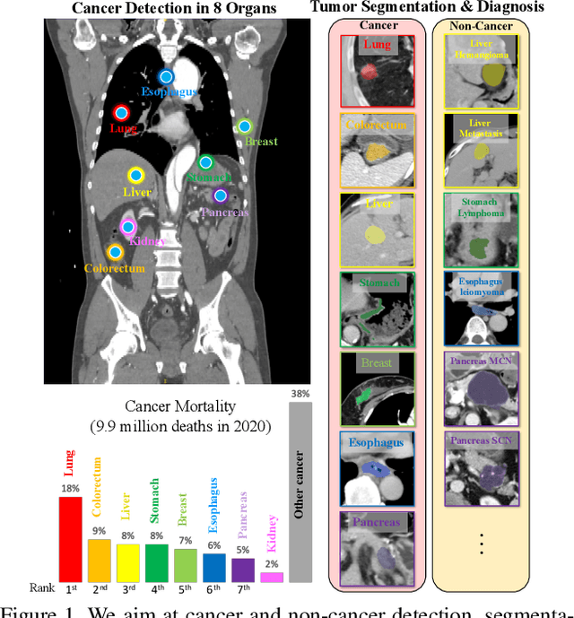 Figure 1 for Towards a Single Unified Model for Effective Detection, Segmentation, and Diagnosis of Eight Major Cancers Using a Large Collection of CT Scans