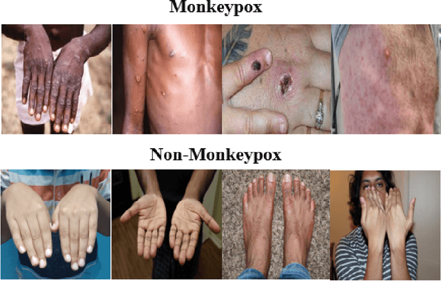 Figure 1 for Transfer learning and Local interpretable model agnostic based visual approach in Monkeypox Disease Detection and Classification: A Deep Learning insights