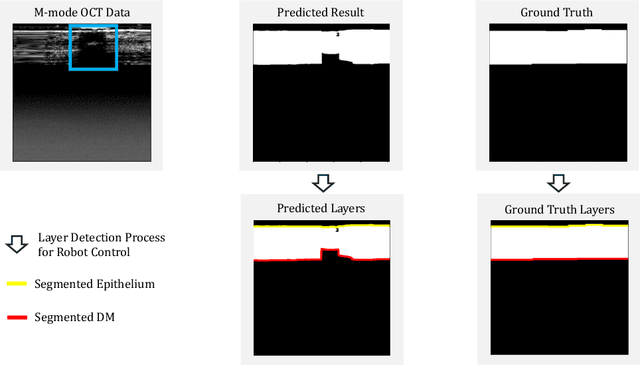 Figure 1 for Topology-based deep-learning segmentation method for deep anterior lamellar keratoplasty (DALK) surgical guidance using M-mode OCT data