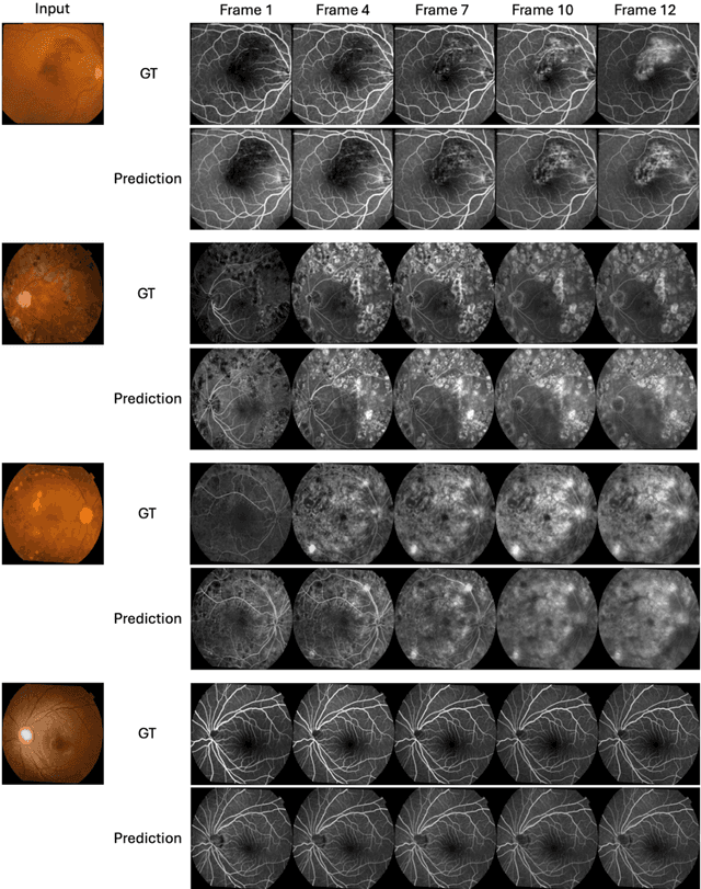 Figure 3 for Fundus to Fluorescein Angiography Video Generation as a Retinal Generative Foundation Model