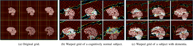 Figure 1 for Efficient Brain Imaging Analysis for Alzheimer's and Dementia Detection Using Convolution-Derivative Operations