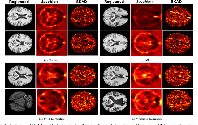 Figure 3 for Efficient Brain Imaging Analysis for Alzheimer's and Dementia Detection Using Convolution-Derivative Operations