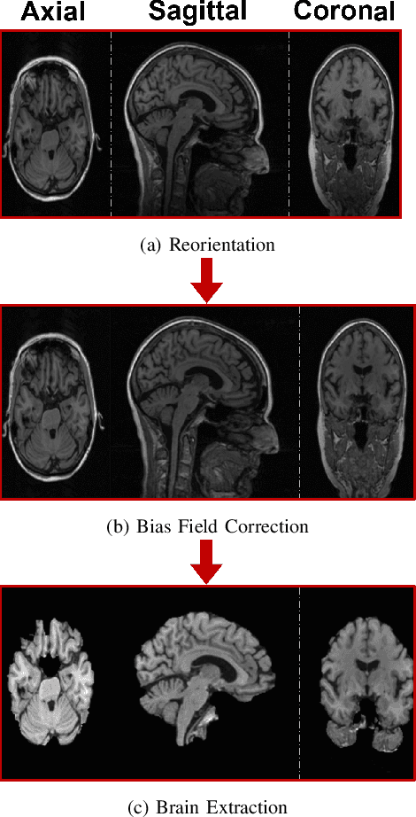 Figure 4 for Efficient Brain Imaging Analysis for Alzheimer's and Dementia Detection Using Convolution-Derivative Operations