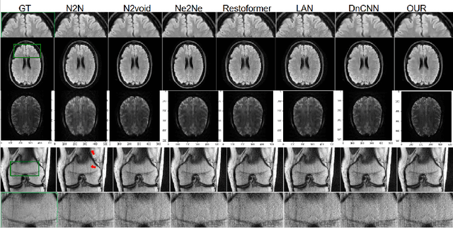 Figure 4 for Denoising via Repainting: an image denoising method using layer wise medical image repainting