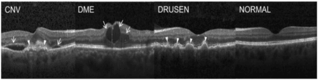 Figure 4 for Eye Disease Prediction using Ensemble Learning and Attention on OCT Scans