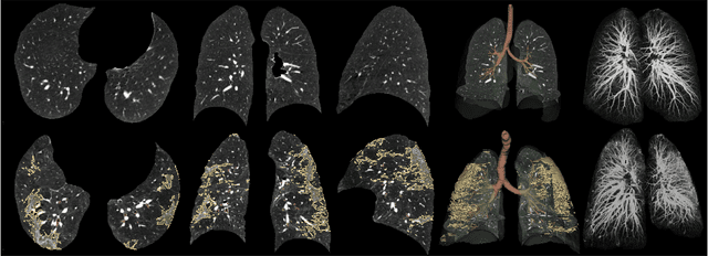 Figure 3 for Automatic segmentation of lung findings in CT and application to Long COVID