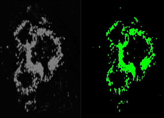 Figure 2 for Detecting diabetic retinopathy severity through fundus images using an ensemble of classifiers