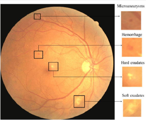 Figure 3 for Detecting diabetic retinopathy severity through fundus images using an ensemble of classifiers