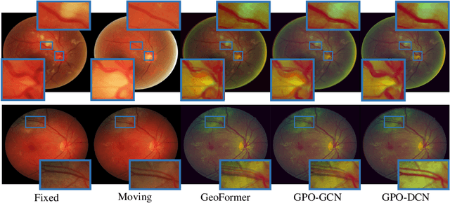 Figure 4 for Gaussian Primitive Optimized Deformable Retinal Image Registration