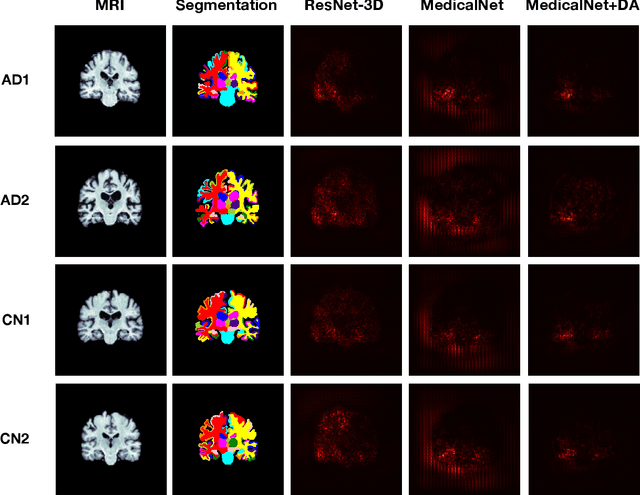 Figure 1 for A Quantitative Approach for Evaluating Disease Focus and Interpretability of Deep Learning Models for Alzheimer's Disease Classification