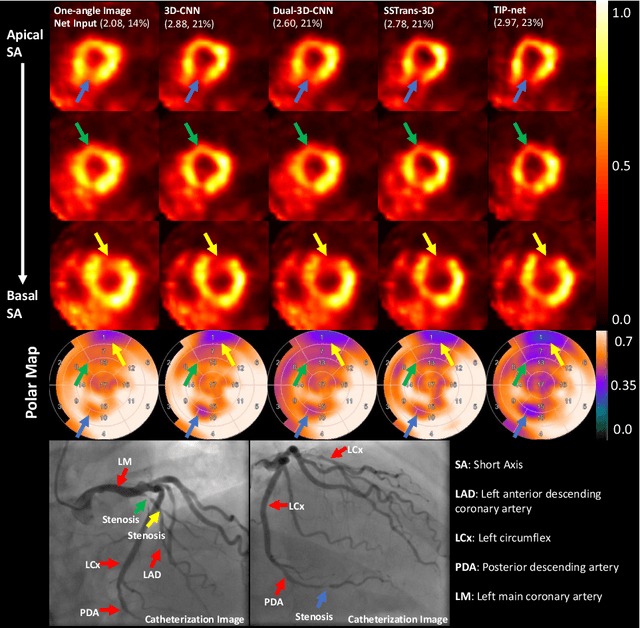 Figure 2 for Transformer-based Dual-domain Network for Few-view Dedicated Cardiac SPECT Image Reconstructions