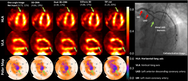 Figure 3 for Transformer-based Dual-domain Network for Few-view Dedicated Cardiac SPECT Image Reconstructions