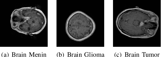 Figure 1 for From Images to Insights: Transforming Brain Cancer Diagnosis with Explainable AI