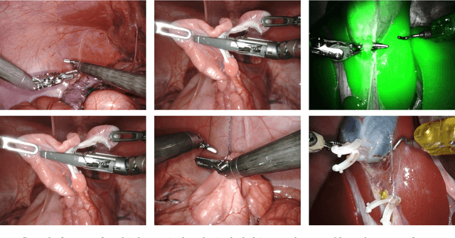 Figure 1 for Surgical Visual Understanding (SurgVU) Dataset