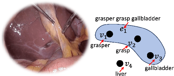 Figure 2 for Hypergraph-Transformer (HGT) for Interactive Event Prediction in Laparoscopic and Robotic Surgery