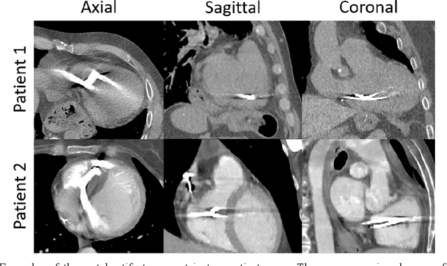 Figure 1 for Small metal artifact detection and inpainting in cardiac CT images