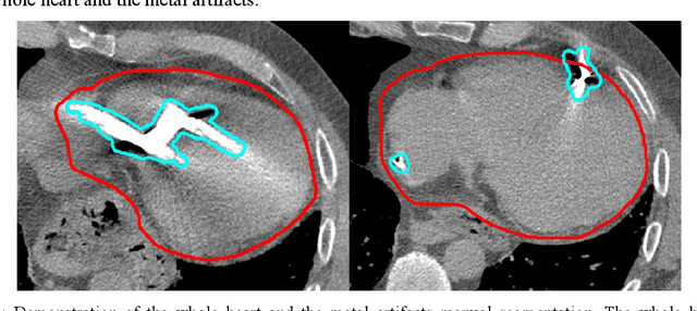 Figure 3 for Small metal artifact detection and inpainting in cardiac CT images