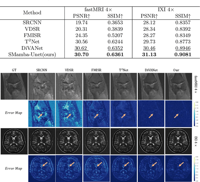 Figure 4 for Self-Prior Guided Mamba-UNet Networks for Medical Image Super-Resolution