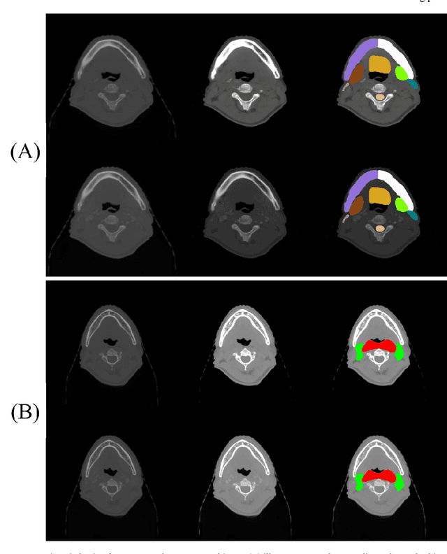 Figure 3 for Fully Automatic Segmentation of Gross Target Volume and Organs-at-Risk for Radiotherapy Planning of Nasopharyngeal Carcinoma
