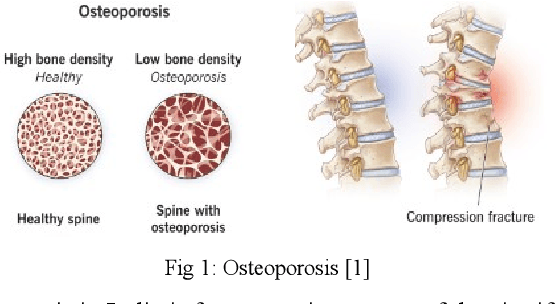 Figure 1 for Analysing Osteoporosis Detection: A Comparative Study of CNN and FNN