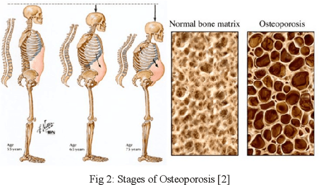 Figure 3 for Analysing Osteoporosis Detection: A Comparative Study of CNN and FNN