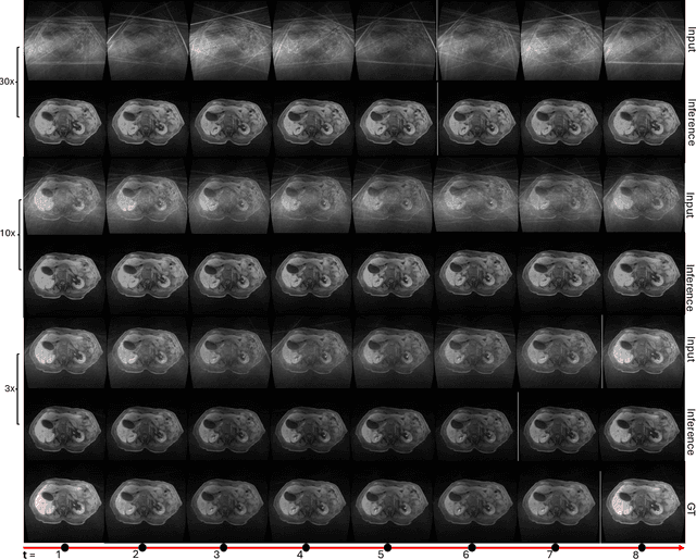 Figure 4 for Rapid Reconstruction of Extremely Accelerated Liver 4D MRI via Chained Iterative Refinement