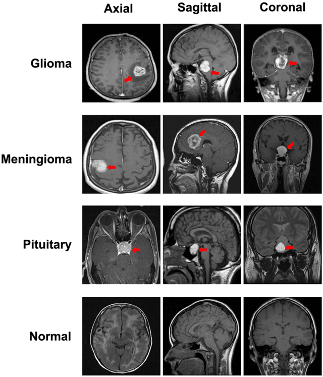 Figure 3 for Robust Brain MRI Image Classification with SIBOW-SVM