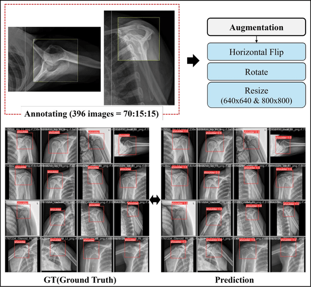 Figure 2 for Preoperative Rotator Cuff Tear Prediction from Shoulder Radiographs using a Convolutional Block Attention Module-Integrated Neural Network