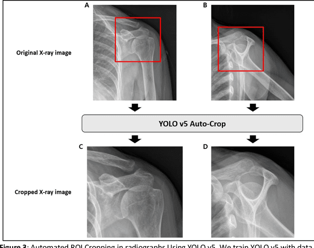 Figure 3 for Preoperative Rotator Cuff Tear Prediction from Shoulder Radiographs using a Convolutional Block Attention Module-Integrated Neural Network