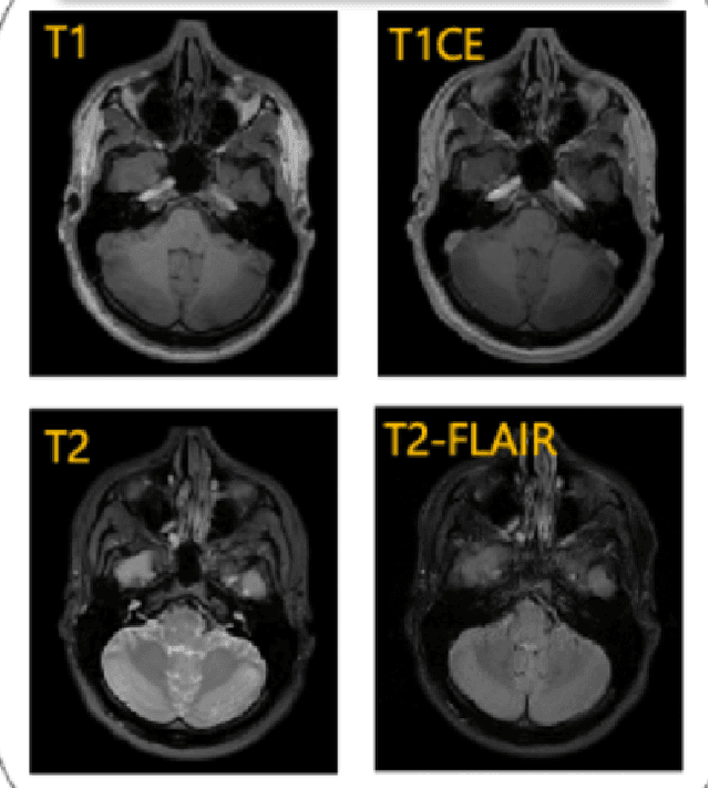 Figure 1 for 3D Graph Attention Networks for High Fidelity Pediatric Glioma Segmentation