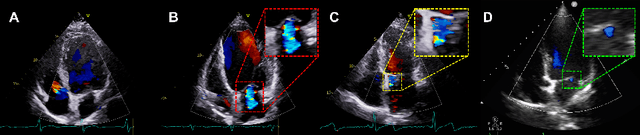 Figure 1 for Mitral Regurgitation Recogniton based on Unsupervised Out-of-Distribution Detection with Residual Diffusion Amplification