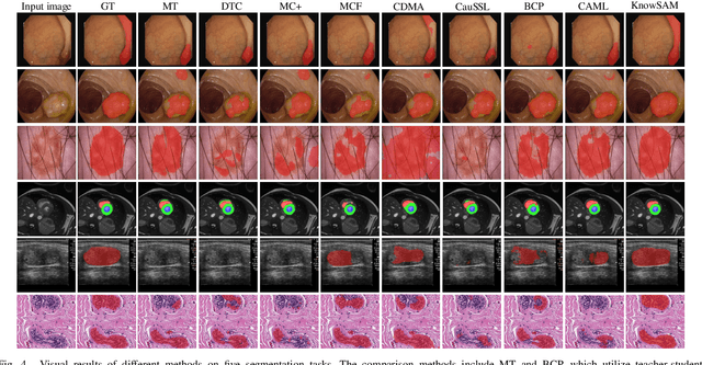 Figure 4 for Learnable Prompting SAM-induced Knowledge Distillation for Semi-supervised Medical Image Segmentation