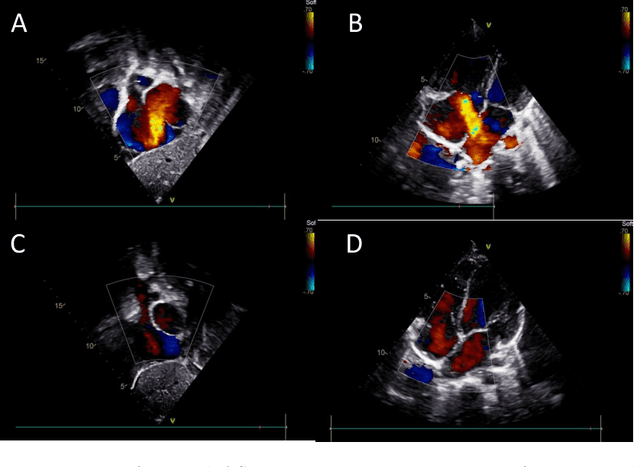 Figure 3 for Atrial Septal Defect Detection in Children Based on Ultrasound Video Using Multiple Instances Learning