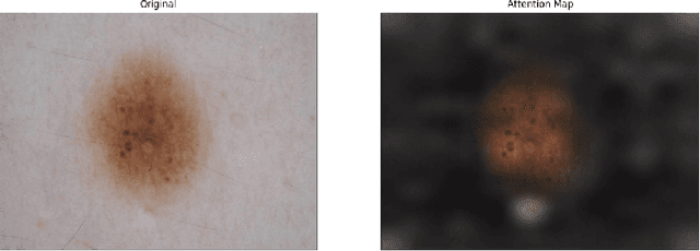 Figure 2 for SkinDistilViT: Lightweight Vision Transformer for Skin Lesion Classification