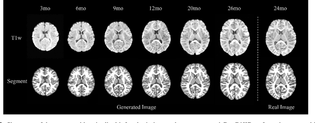 Figure 3 for Cas-DiffCom: Cascaded diffusion model for infant longitudinal super-resolution 3D medical image completion