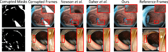 Figure 1 for Depth-Aware Endoscopic Video Inpainting