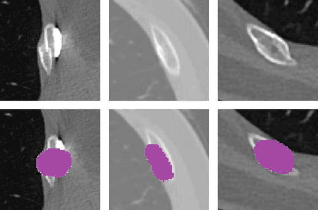 Figure 1 for Leveraging Auxiliary Classification for Rib Fracture Segmentation