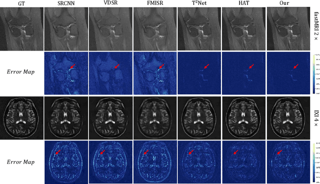 Figure 4 for Deform-Mamba Network for MRI Super-Resolution