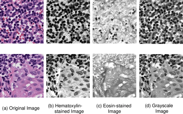 Figure 3 for The Whole Pathological Slide Classification via Weakly Supervised Learning