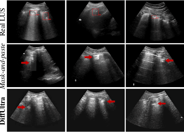 Figure 1 for Ultrasound Image Synthesis Using Generative AI for Lung Ultrasound Detection