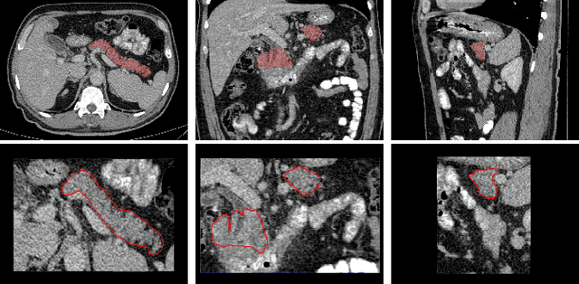 Figure 2 for Detection of Peri-Pancreatic Edema using Deep Learning and Radiomics Techniques