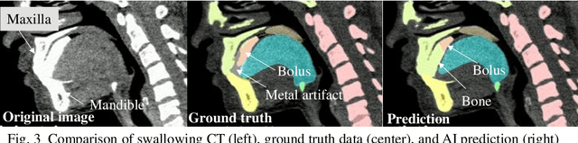 Figure 3 for Visualization of Organ Movements Using Automatic Region Segmentation of Swallowing CT