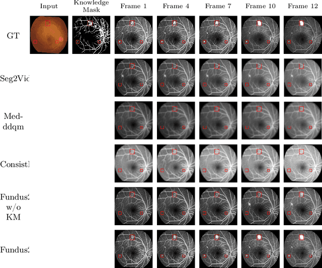 Figure 4 for Fundus2Video: Cross-Modal Angiography Video Generation from Static Fundus Photography with Clinical Knowledge Guidance