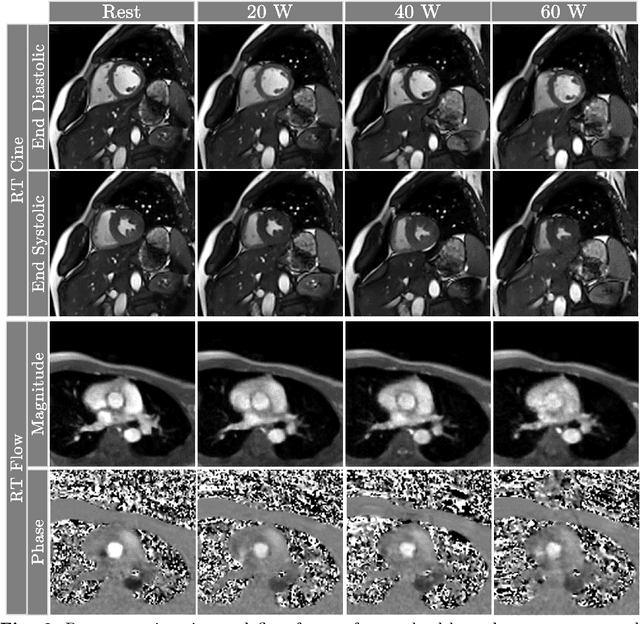 Figure 4 for Accelerated Real-time Cine and Flow under In-magnet Staged Exercise