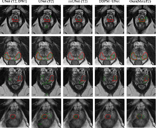 Figure 3 for T2-Only Prostate Cancer Prediction by Meta-Learning from Bi-Parametric MR Imaging