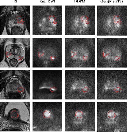 Figure 4 for T2-Only Prostate Cancer Prediction by Meta-Learning from Bi-Parametric MR Imaging