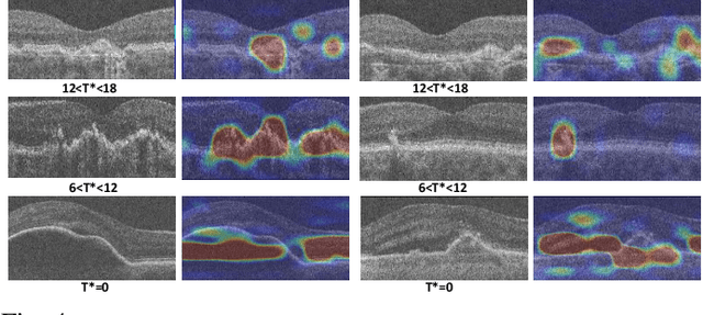 Figure 4 for Morph-SSL: Self-Supervision with Longitudinal Morphing to Predict AMD Progression from OCT